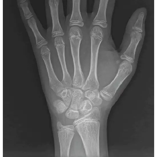x-ray bone age study